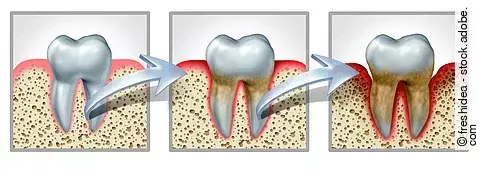 Illustration: 3 Zähne mit Zahnfleisch nebeneinander: links: Zahn mit gesundem Zahnfleisch, Mitte: oberflächlich rotes Zahnfleisch, rechts: Parodontitis um den gesamten Zahn und die Zahnwurzel gekennzeichnet durch rote Einfärbung