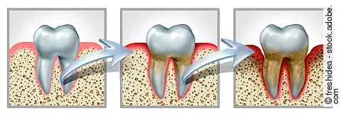 Illustration: 3 Zähne mit Zahnfleisch nebeneinander: links: Zahn mit gesundem Zahnfleisch, Mitte: oberflächlich rotes Zahnfleisch, rechts: Parodontitis um den gesamten Zahn und die Zahnwurzel gekennzeichnet durch rote Einfärbung