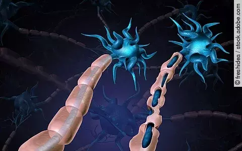 Illustration: Nervenfasern mit geschädigter Myelinschicht bei MS