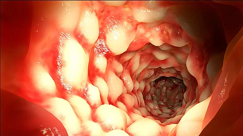 Darm mit Morbus Crohn
