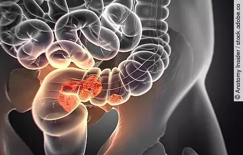 Darmkrebs, medizinische Illustration