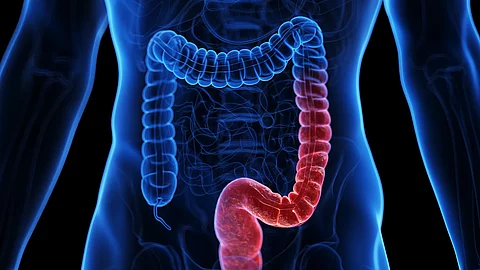 Illustration: entzündeter Darm 