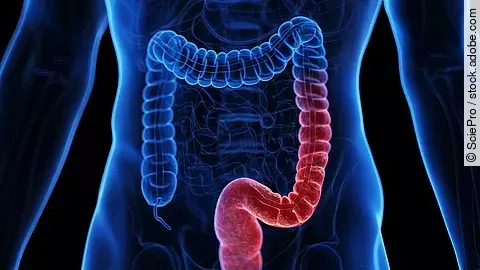 Illustration: entzündeter Darm 