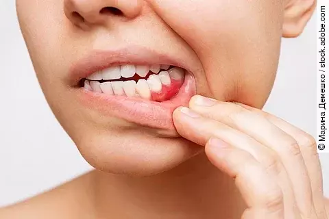 Frau zeigt ihr entzündetes Zahnfleisch