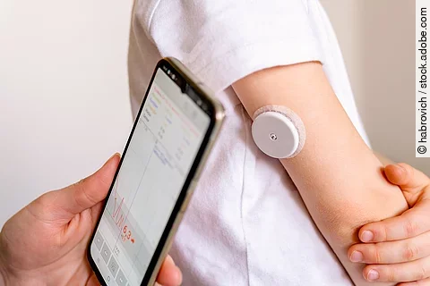 Blutzuckermesssystem am Oberarm einer Person, daneben ein Smartphone mit den Ergebnissen