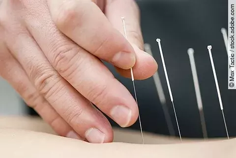 Eine Hand setzt Akupunkturnadeln auf einen Patienten