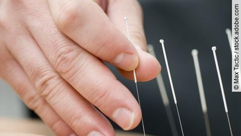Akupunkturbehandlung, Hand setzt Nadeln