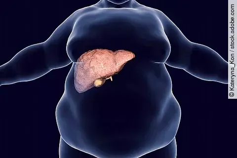 Illustration: Übergewichtiger Mann mit Fettleber