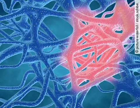 Grafische Darstellung einer Entzündung im Gewebe.