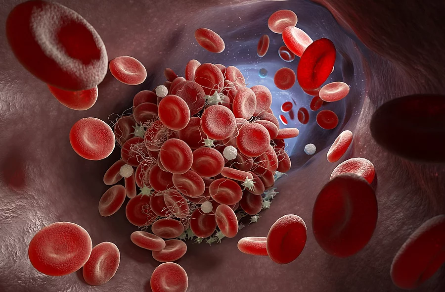 Illustration: Thrombus in einem Blutgefäß
