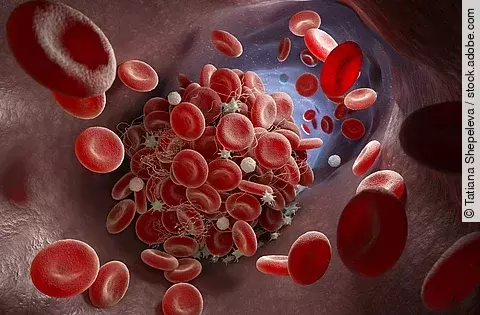 Illustration: Thrombus in einem Blutgefäß