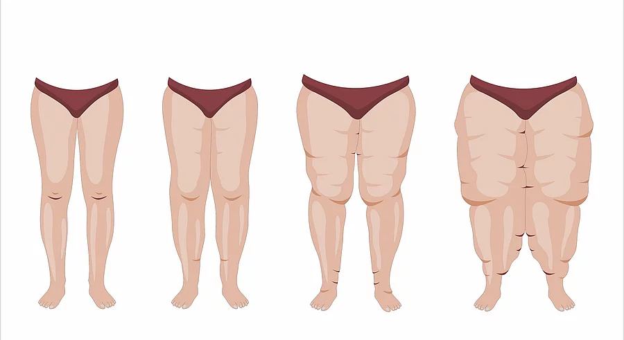 Illustration: 4 Stadien des Lipödems