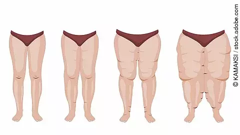 Lipedema stages and symptoms illustration Illustration: Lipödem-Stadien 1-3