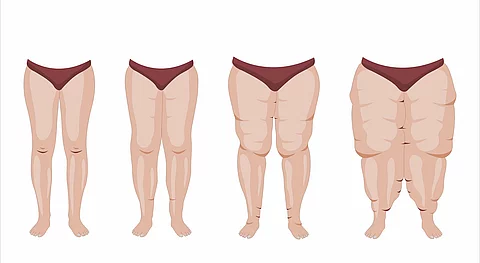 Lipedema stages and symptoms illustration Illustration: Lipödem-Stadien 1-3
