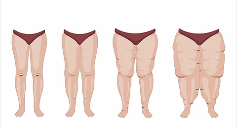 Illustration: 4 Stadien des Lipödems