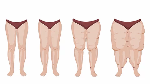 Lipedema stages and symptoms illustration Illustration: 4 Stadien des Lipödems