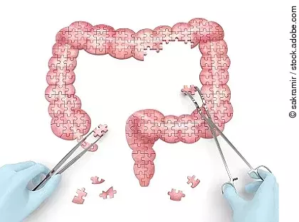 Darm als Puzzle. Arzt setzt Puzzleteile zusammen mit chirurgischen Instrumenten.