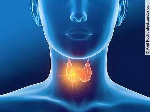 Schilddrüse, Thyreoiditis, Hashimoto, Frau
