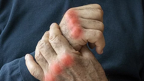 Hände eines älteren Menschen mit Arthrose. 