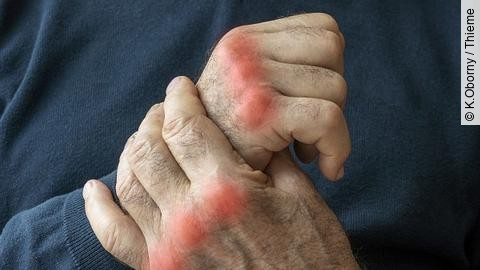 Hände eines älteren Menschen mit Arthrose. 