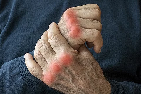 Hände eines älteren Menschen mit Arthrose. 