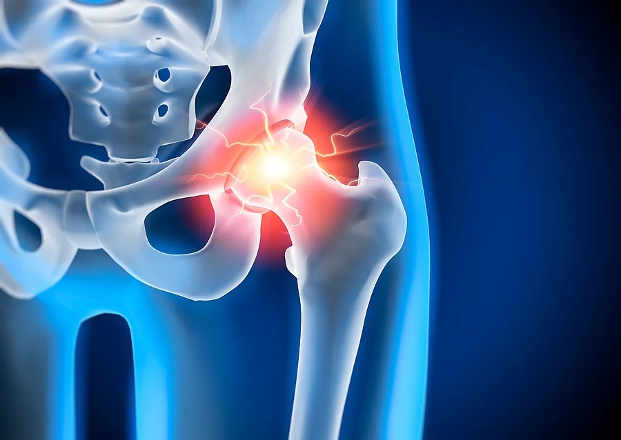 Anatomische Illustration: Becken mit schmerzendem Hüftgelenk