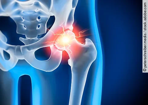 Anatomische Illustration: Becken mit schmerzendem Hüftgelenk