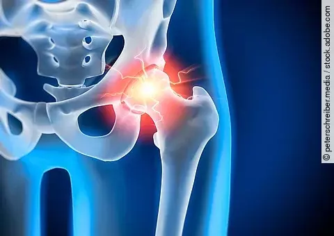 Anatomische Illustration: Becken mit schmerzendem Hüftgelenk