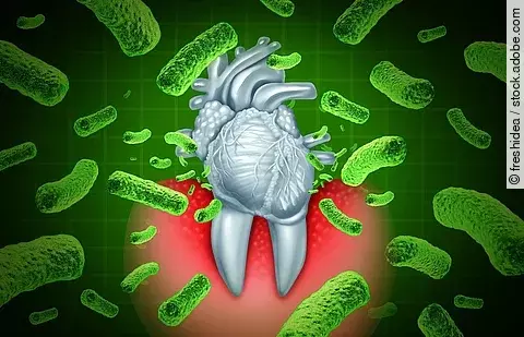 Parodontitis: Zahn mit entzündetem Zahnbett umgeben von Bakterien
