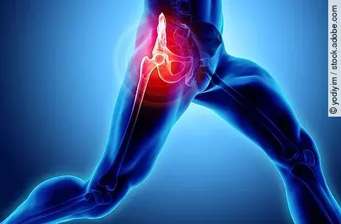 Illustration: Schmerz im Hüftgelenk