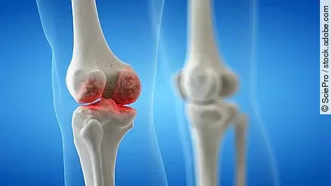 medizinische Illustration: gesundes und krankes Kniegelenk