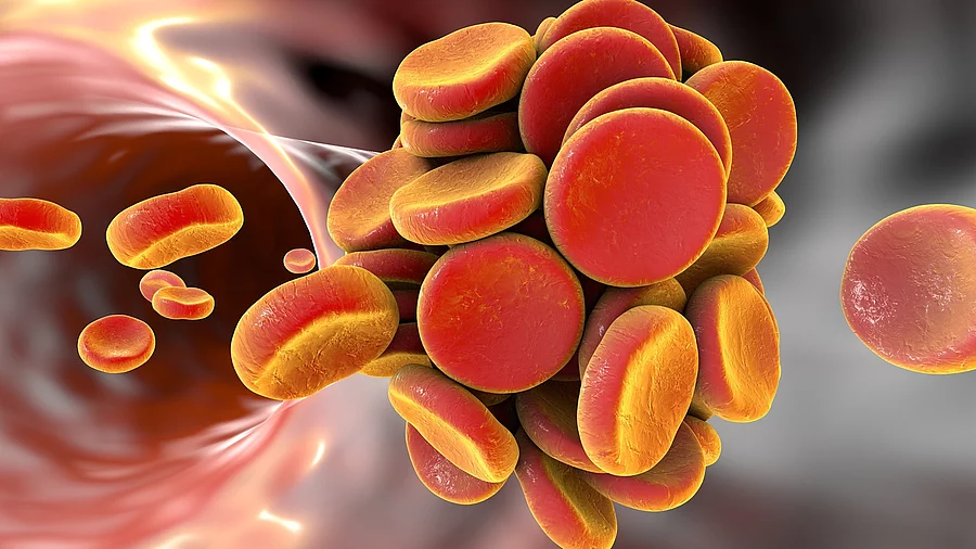 Illustration: Thrombus in einem Blutgefäß