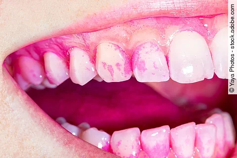 Zähne mit Plaqueverfärbungen und Indikator 