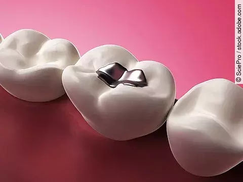 Illustration: 3 Zähne, der mittlere mit Amalgamfüllung