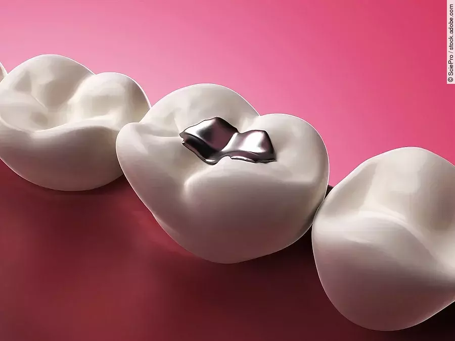 3d rendered illustration of an amalgam filling Illustration: 3 Zähne, der mittlere mit Amalgamfüllung
