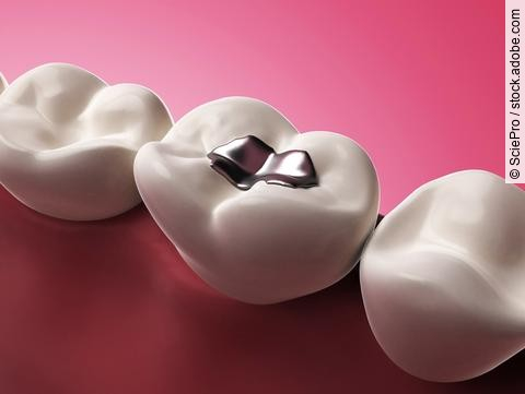 Illustration: Amalgamfüllung zwischen 2 gesunden weißen Zähnen