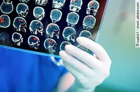 Arzt hält das Ergebnis einer MRT Untersuchung in den Händen. 