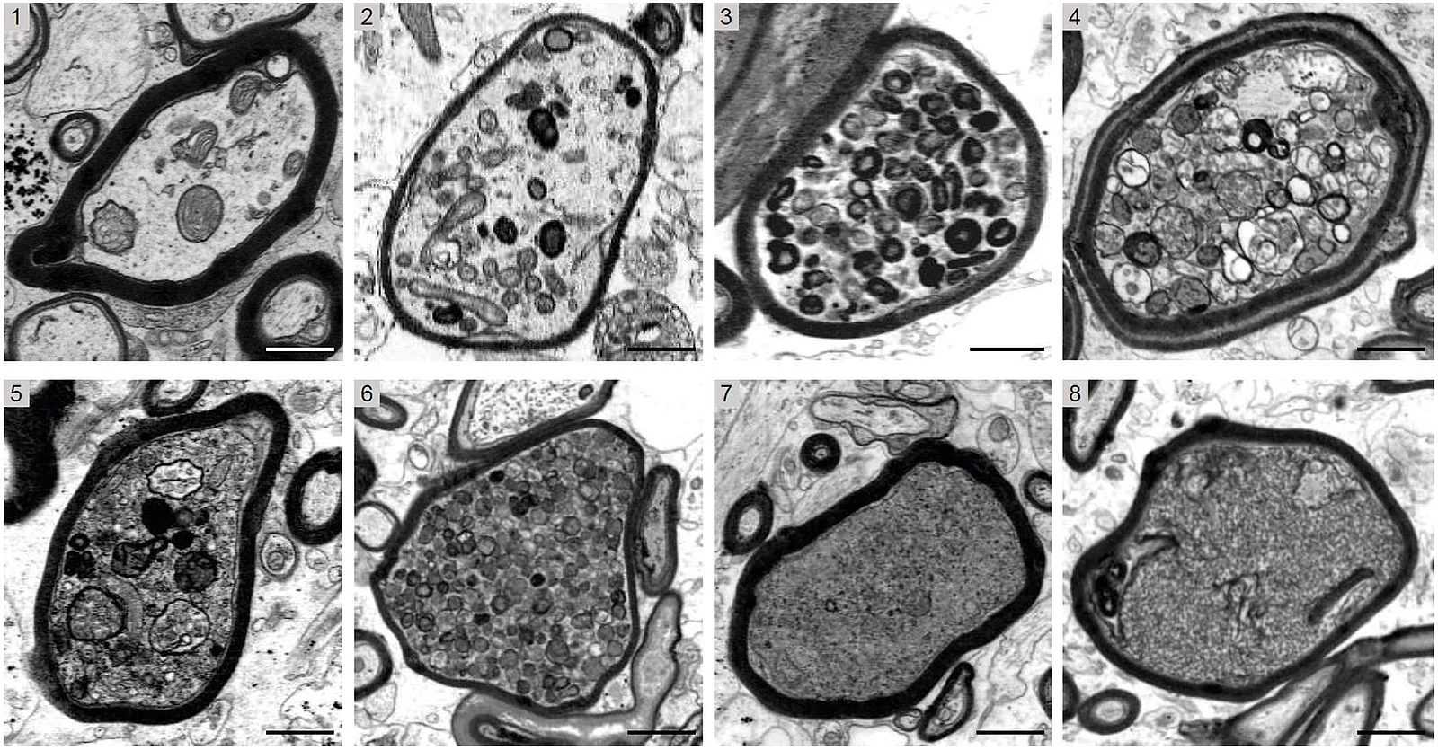 elektronenmikroskopische Aufnahmen aus Hirnbiopsien, die zunehmend starke Schädigungen mit Myelin ummantelter Axone bei MS-Patient*innen zeigen
