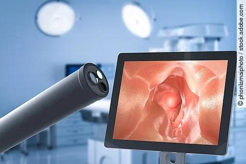 Symbolbild Darmspiegelung: Bildschirm mit Darm von innen und Endoskoprohr