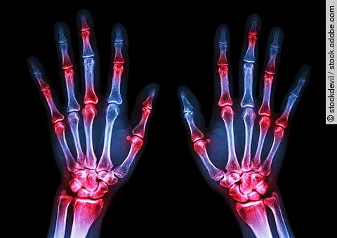 Röntgenbild von zwei Händen auf schwarzem Hintergrund; die Gelenke sind rot markiert.