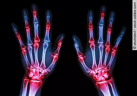 Röntgenbild von zwei Händen auf schwarzem Hintergrund; die Gelenke sind rot markiert.