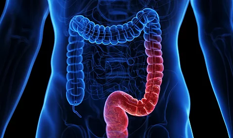 Medizinische Illustration: menschlicher Körper mit entzündetem Darm