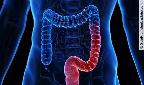 Medizinische Illustration: menschlicher Körper mit entzündetem Darm