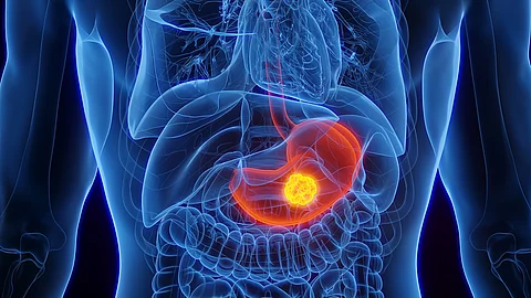 3D-Illustration der inneren Organe eines Mannes mit Magenkrebs, wobei der Magen farblich hervorgehoben ist.