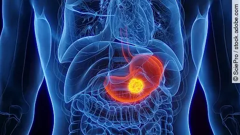 3D-Illustration der inneren Organe eines Mannes mit Magenkrebs, wobei der Magen farblich hervorgehoben ist.