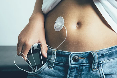 junger Diabetes Patient mit am Bauch befestigter Insulinpumpe