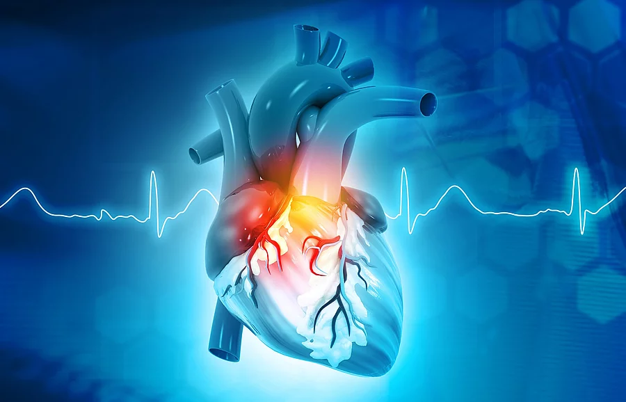 Modell eines Herzens mit farblich gekennzeichnetem problematischem Bereich, im Hintergrund eine EKG-Kurve
