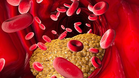 Gelbe Cholesterinablagerungen in einem Blutgefäß mit roten Blutkörperchen