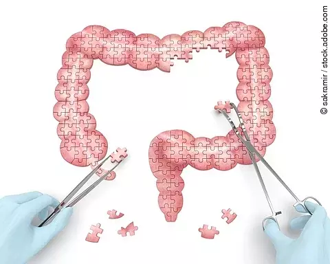 Darm als Puzzle, welches von Händen in blauen Handschuhen und Instrumenten zusammengesetzt wird.