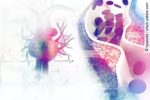 Blutgefäß mit Arteriosklerose, Gefäßverschluss, Illustration